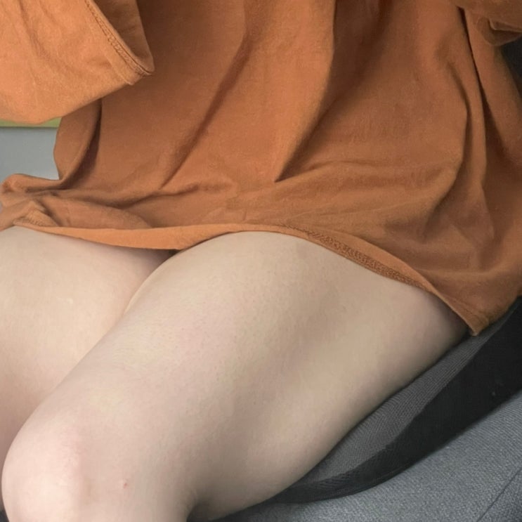  하체비만 허벅지 통통이 30년 부천다이어트병원 지방추출주사 다이어트 시작