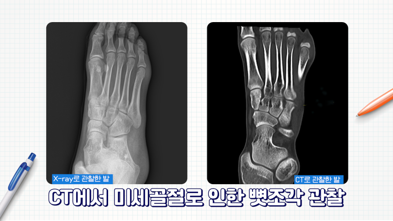 [CT vs MRI 완벽 정리] 영상의학과 전문의가 가르치는 CT와 MRI 검사 원리 [소요시간] 조영제 부작용? 8