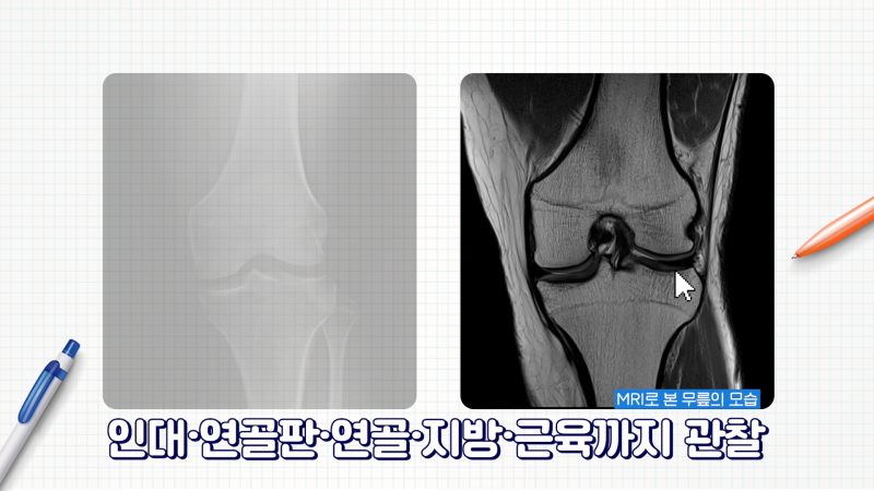 [CT vs MRI 완벽 정리] 영상의학과 전문의가 가르치는 CT와 MRI 검사 원리 [소요시간] 조영제 부작용? 4
