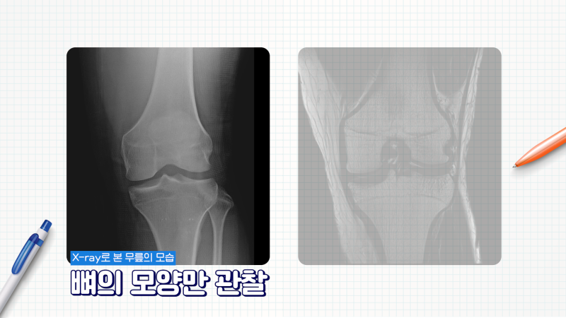 [CT vs MRI 완벽 정리] 영상의학과 전문의가 가르치는 CT와 MRI 검사 원리 [소요시간] 조영제 부작용? 7