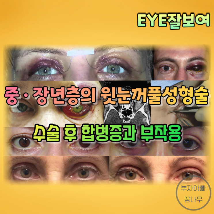 [EYE잘보여] 중년층&장년층의 윗눈꺼풀성형술 (2) - 수술 후 합병증과 부작용