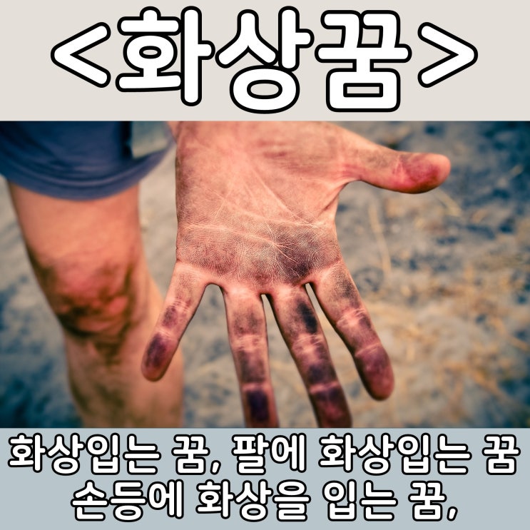  [쉬운 꿈해몽] 화상꿈 :: 화상입는 꿈, 팔에 화상입는 꿈, 손등에 화상을 입는 꿈,