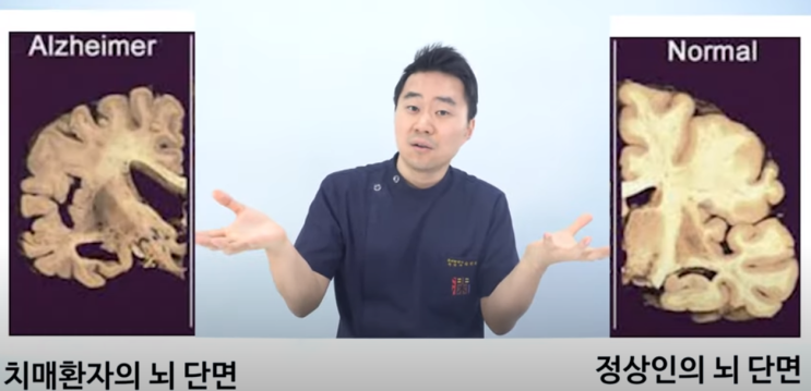  치매를 유발하는 습관(음주, 흡연, 과격한 운동) 및 예방법