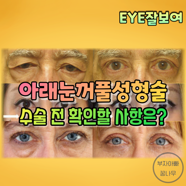 [EYE잘보여] 아래눈꺼풀 성형술 (1) - 수술 전에 확인해봐야 할 것들은?