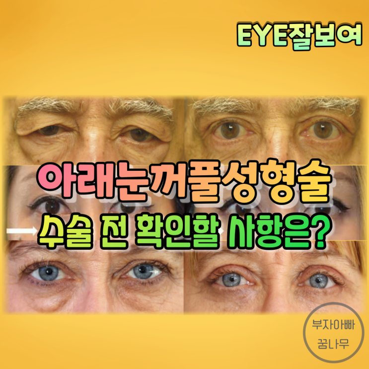  [EYE잘보여] 아래눈꺼풀 성형술 (1) - 수술 전에 확인해봐야 할 것들은?