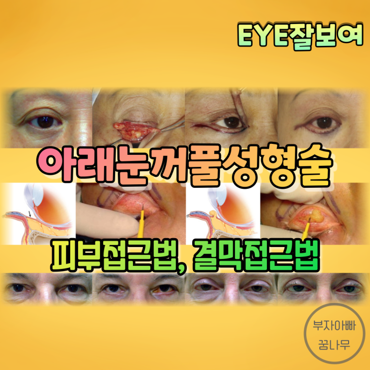 [EYE잘보여] 아래눈꺼풀 성형술 (2) - 피부접근법(Transcutaneous), 결막접근법(Transconjunctival)