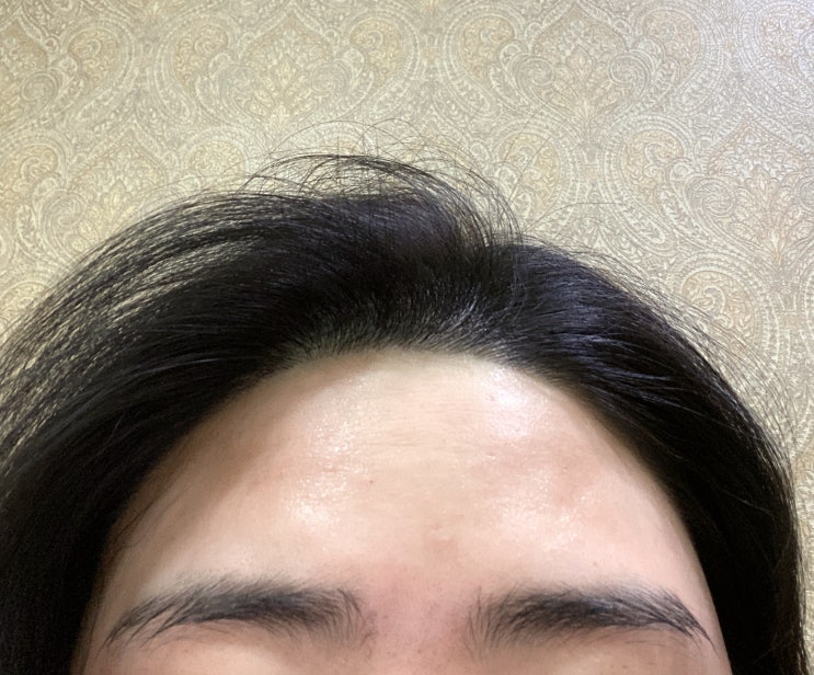  [얼굴 레이저 제모 3, 4회차] 부산 피부과 얼굴 솜털 제모