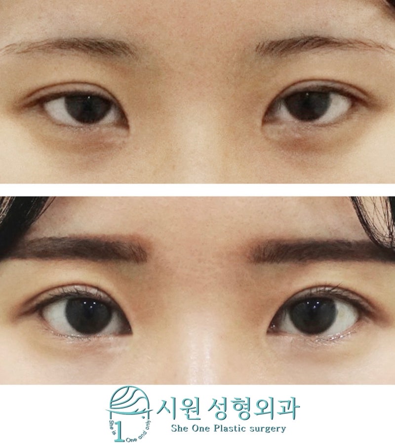 116 쌍꺼풀 주름을 개선하는 절개법 쌍꺼풀 재수술, 몽고 주름 제거 전열림 재수술, 축방향 열림 4개월차 경과, 후기 feat. 시원 정형외과