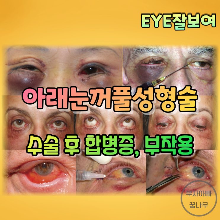 [EYE잘보여] 아래눈꺼풀 성형술 (3) - 무엇을 조심해야할까?: 수술 후 합병증과 부작용