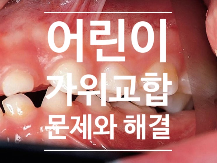 어린이 가위교합, 문제점과 해결 방법 그리고 치료 시기