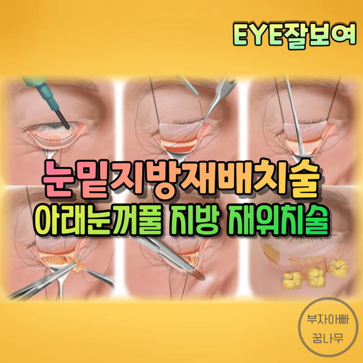 [EYE잘보여] '눈밑지방재배치' - 아래눈꺼풀 지방 재위치술(Lower Eyelid Fat Repositioning): 왜 하나? 어떻게 하지?