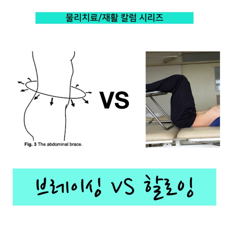 척추 안정화 전략 두 가지 비교 :복부 브레이싱 (abdominal bracing) vs 복부 할로잉(abdominal Hollowing)