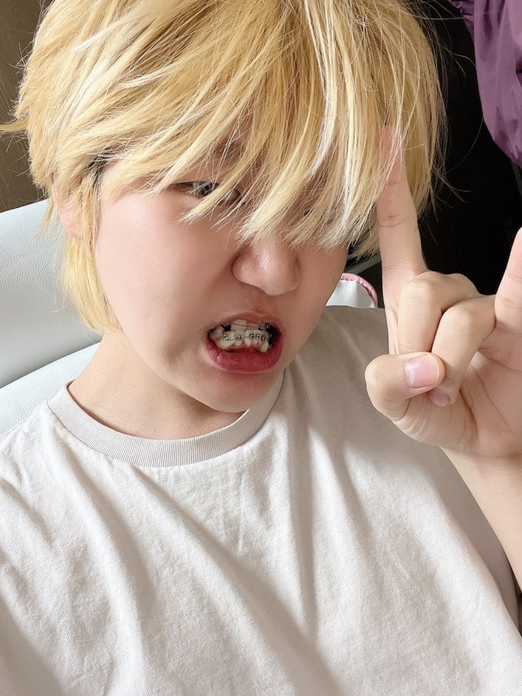  양악수술 준비[4] 치아 교정 첫날 후기 ..!부정교합 선교정 .. ;ㅅ;