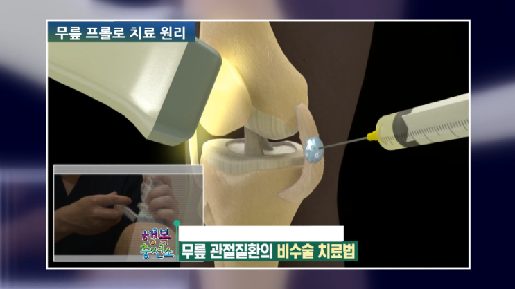  무릎연골손상 치료 수술하지 않고도