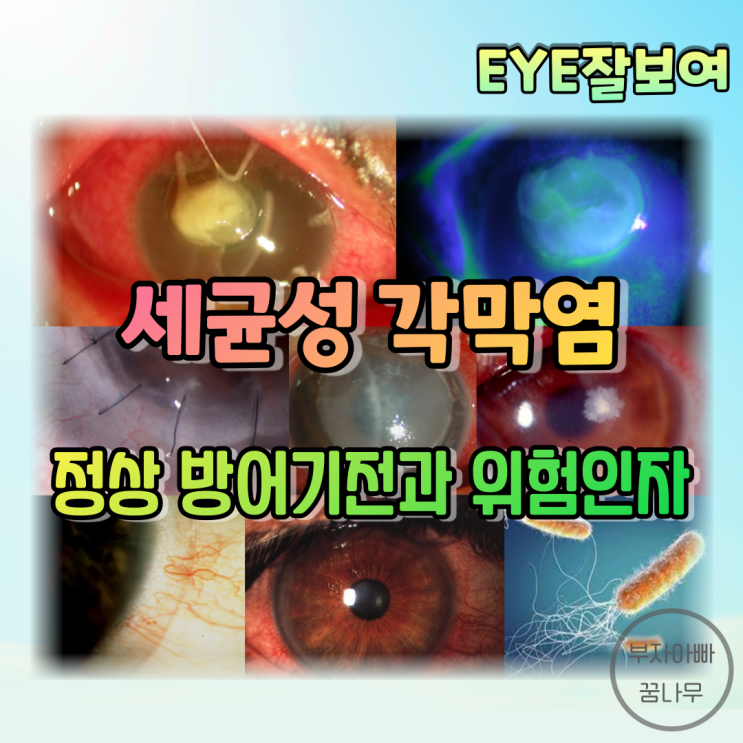  [EYE잘보여] 세균성 각막염(Bacterial Keratitis) 개론 (1) - 정상 각막방어기전, 위험인자