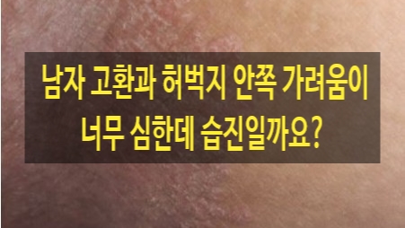  남자 고환과 허벅지 안쪽 가려움이 너무 심한데 습진일까요?