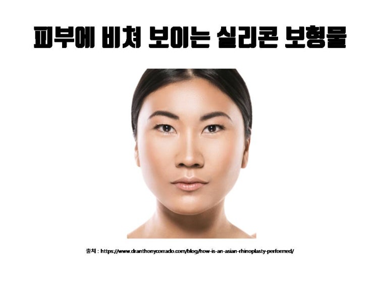  대표적인 수술 한 티 나는 코, 코실리콘 비침!!!