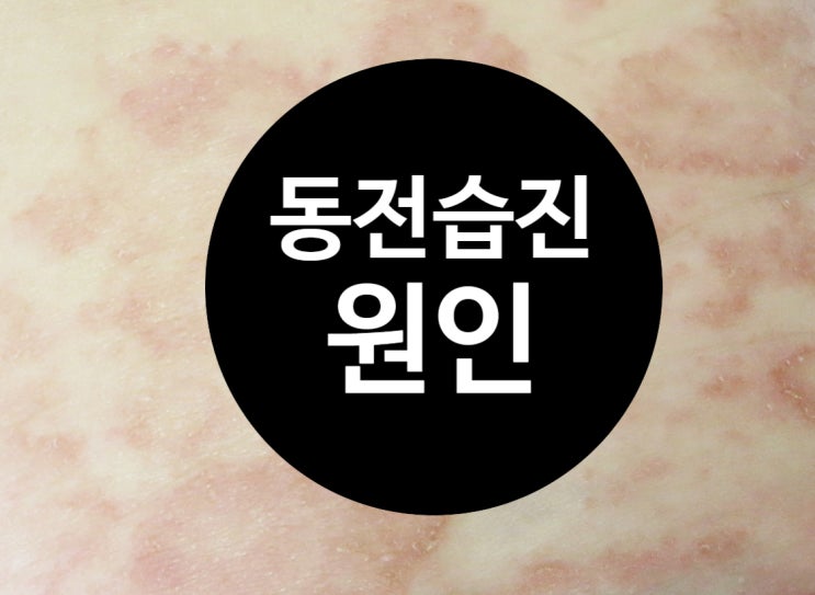  동전습진 원인과 증상, 내 피부 동전습진일까?