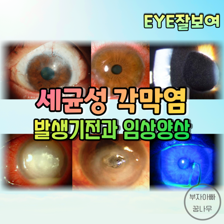 [EYE잘보여] 세균성 각막염(Bacterial Keratitis) 개론 (2) - 발생기전 & 경과 및 임상양상