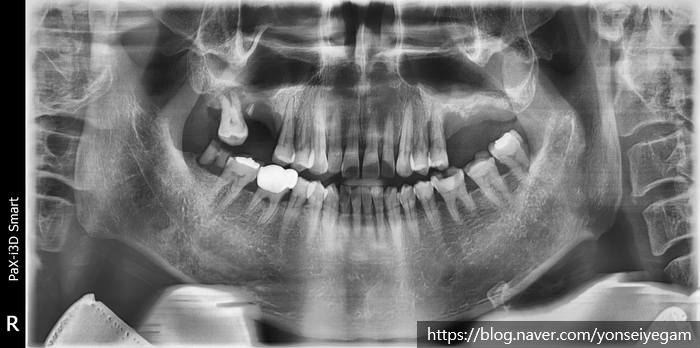 [서울시청역/남대문]어금니임플란트+상악동거상술(뼈이식):실제케이스