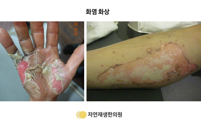 3도 화상 흉터 관리(정말 한 번도 안 되지만)는 계속 노력해야 할 것 같다. 9