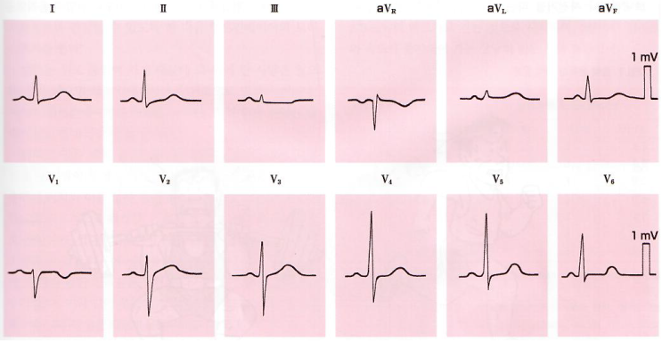  [책 리뷰] “의료인을 위한 ECG” - 표준 12유도 심전도②