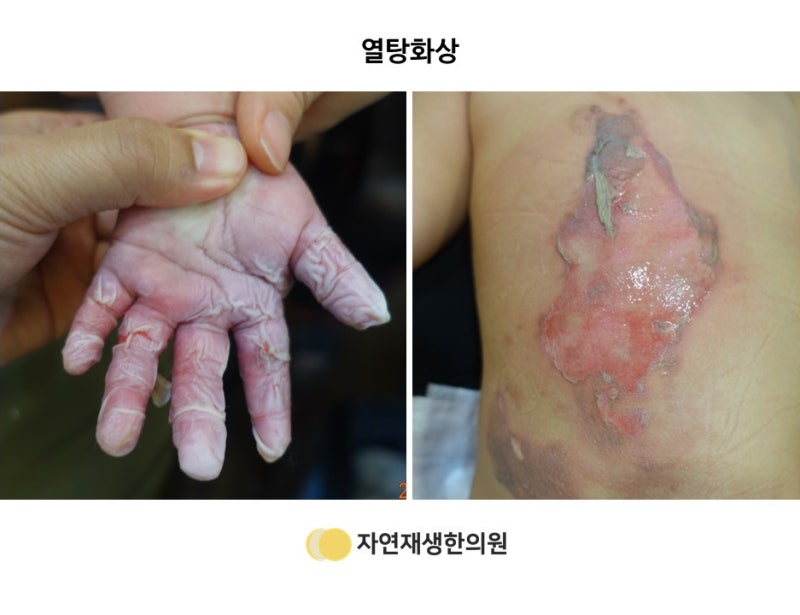 3도 화상 흉터 관리(정말 한 번도 안 되지만)는 계속 노력해야 할 것 같다. 3