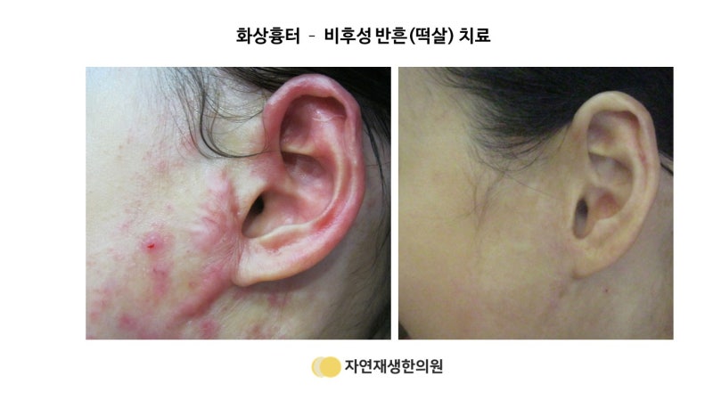 화상 입었을때 응급처치 및 1도 2도 3도 화상 치료 과정 : 네이버 블로그