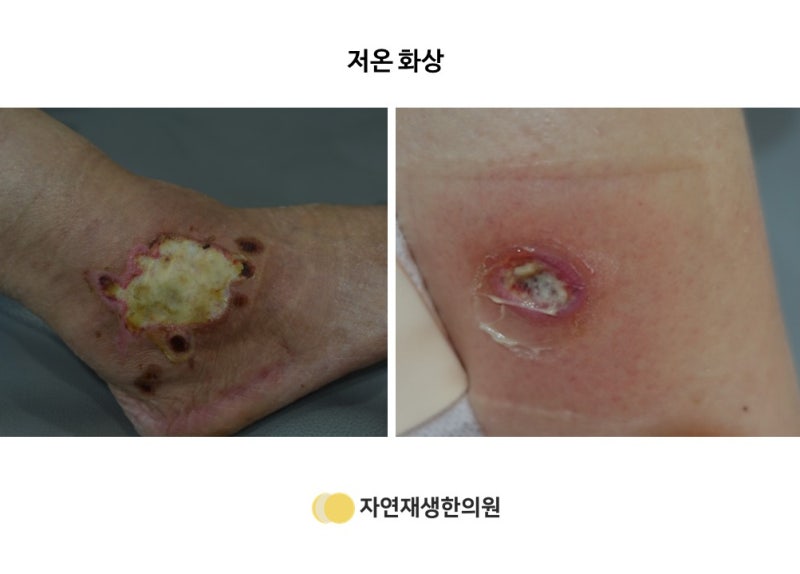 3도 화상 흉터 관리(정말 한 번도 안 되지만)는 계속 노력해야 할 것 같다. 10