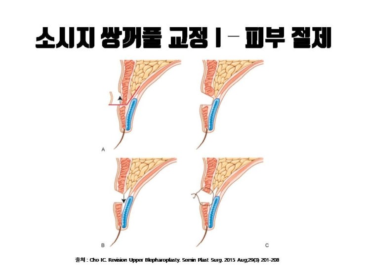  스트레스 팍팍 주는 소세지 쌍꺼풀에 대한 모든 것 알려드려요!!!