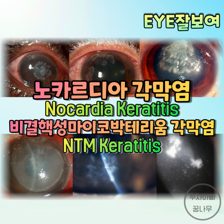[EYE잘보여] 노카르디아 각막염(Nocardia Keratitis), 비결핵성 마이코박테리움 각막염(NonTuberculosis Mycobaterium Keratitis)