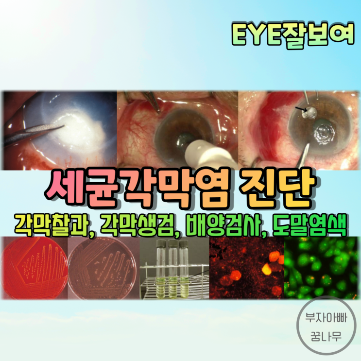  [EYE잘보여] 세균성 각막염(각막궤양)의 진단 - 각막찰과, 결막찰과, 각막생검, 배양검사, 도말염색검사