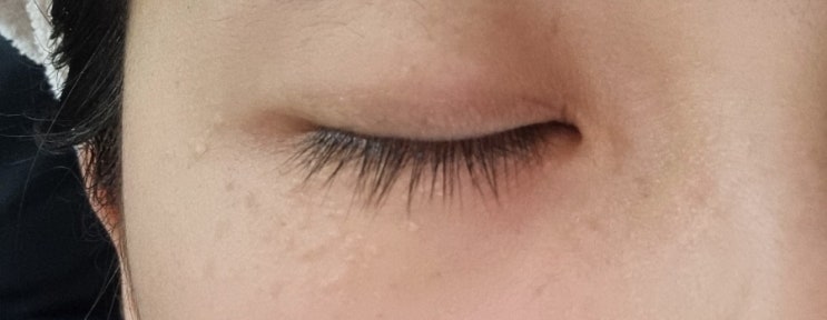  이효리도 못고친 눈밑 한관종 신생아 비립종 원인 제거 치료방법