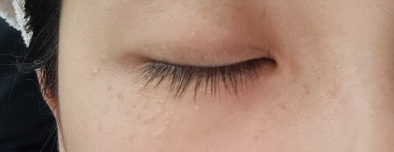 이효리도 못고친 눈밑 한관종 신생아 비립종 원인 제거 치료방법