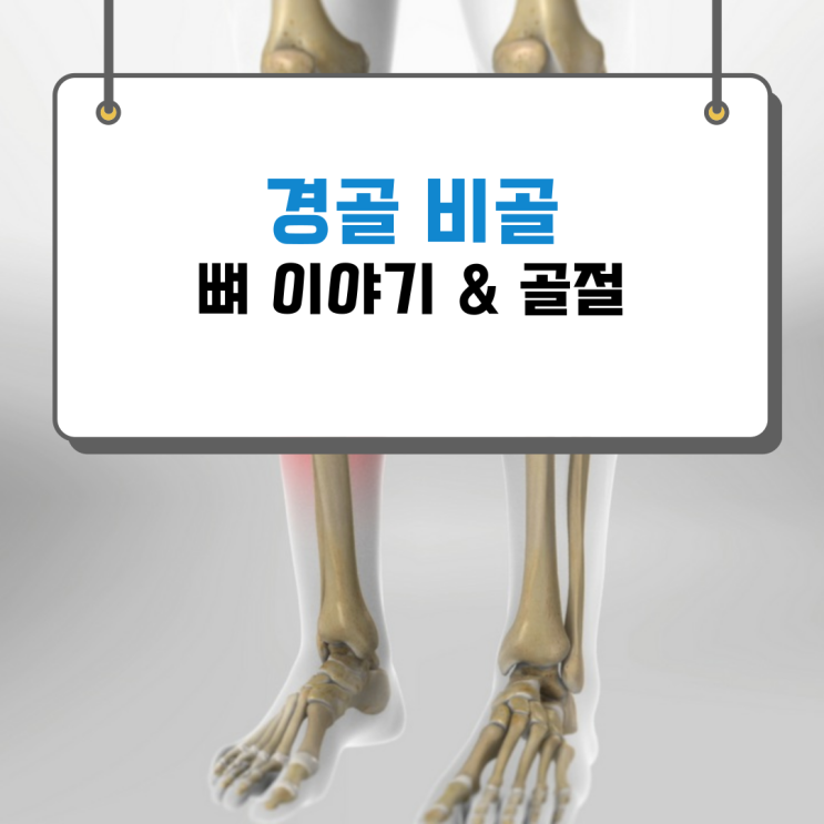 경골 골절, 비골 그리고 뼈 이야기