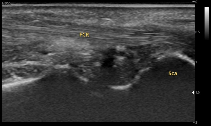 요측수근굴근 Flexor carpi radialis FCR 노쪽손목굽힘근 손목 통증 결절종 초음파검사 : 네이버 블로그