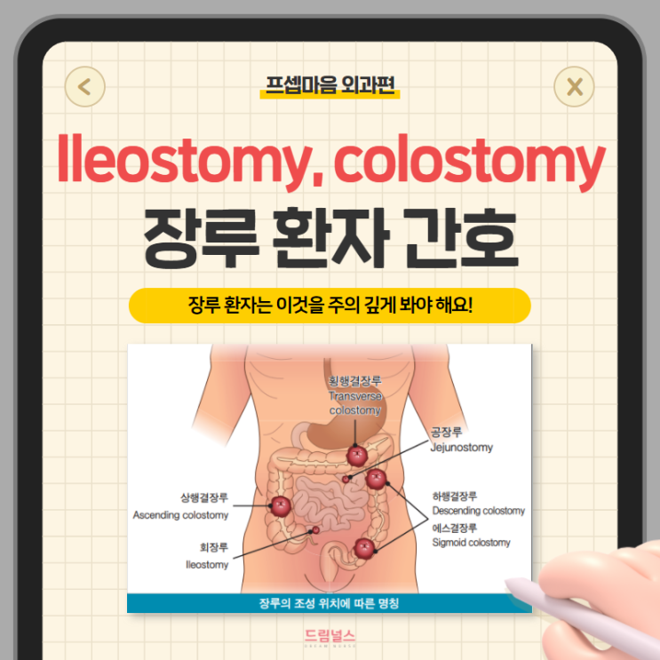 Ileostomy colostomy 장루 환자 간호 | 이것을 주의 깊게 봐야 해요!