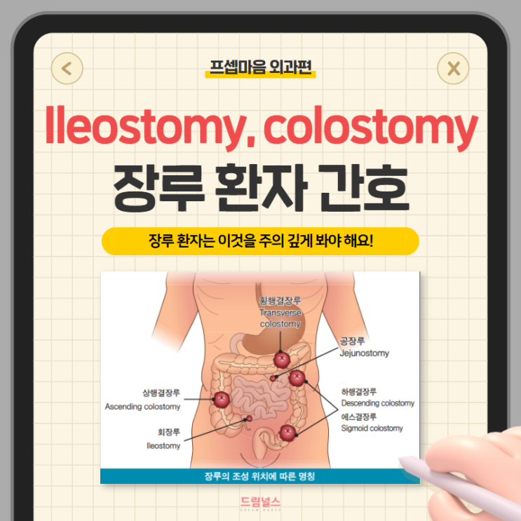 Ileostomy colostomy 장루 환자 간호 | 이것을 주의 깊게 봐야 해요! Ileostomy colostomy 장루 환자 간호 | 이것을 주의 깊게 봐야 해요!