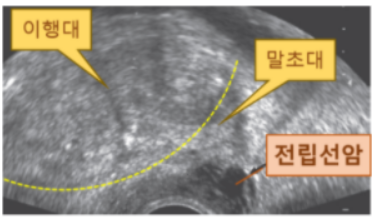 전립선암 초음파 검사 소견 : 네이버 블로그