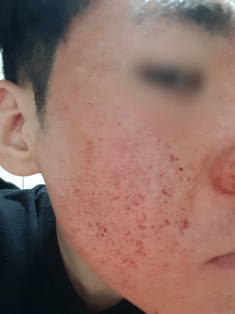 청주여드름피부과 흉터치료 피코프락셀 5배 효과는?