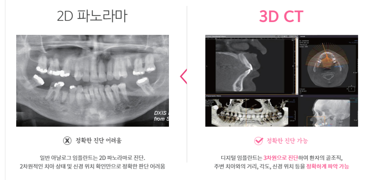 서대문역 가까운 치과 비절개 네비게이션임플란트 소개;덜아프게 빠른 회복위한