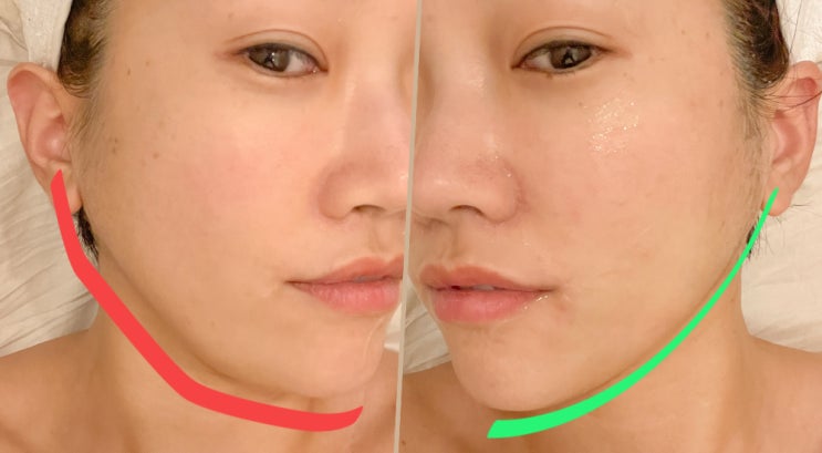  별내 피부관리, 메종드에스떼에서 브이라인 관리 받았어요