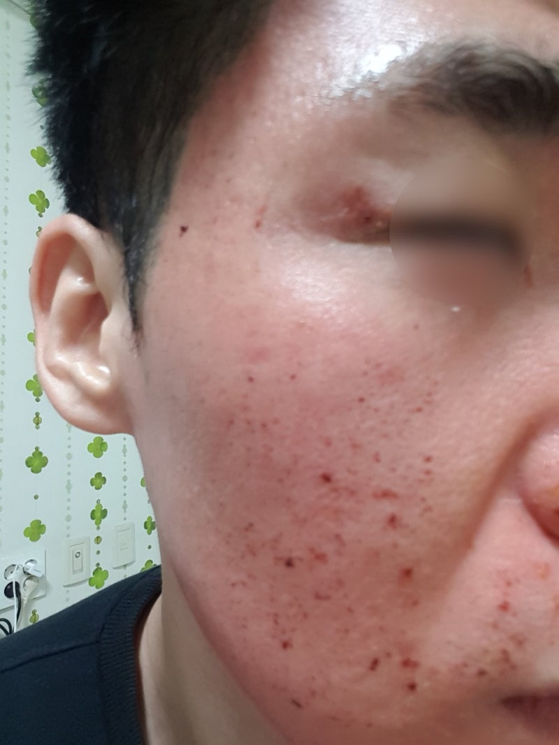 청주여드름피부과 흉터치료 피코프락셀 5배 효과는? 4