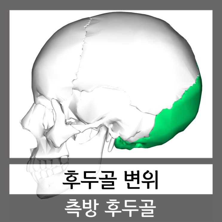  카이로프랙틱 후두골 변위(Occipital Subluxation)