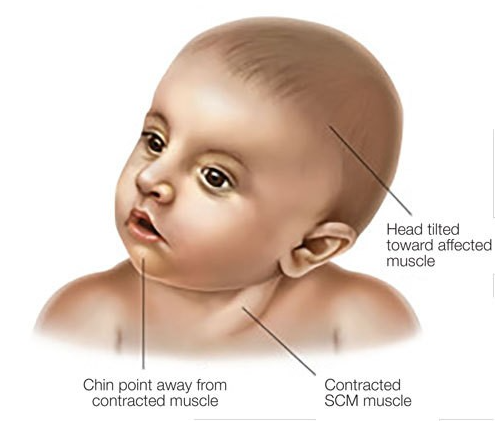  신생아 사경(Torticollis) 이란 무엇인가?증상 및 기본정보