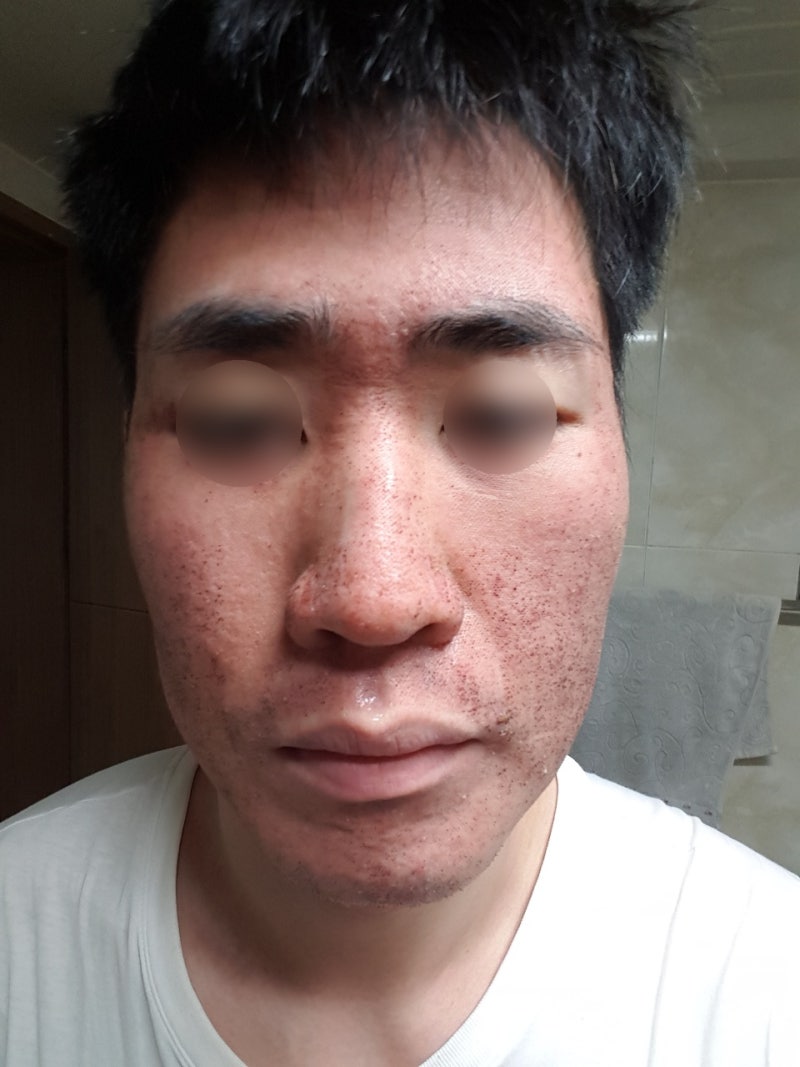 청주여드름피부과 흉터치료 피코프락셀 5배 효과는? 5