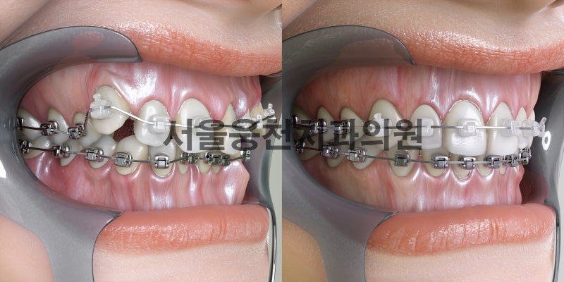 신월동치과 보철치료의 장단점을 알아보겠습니다