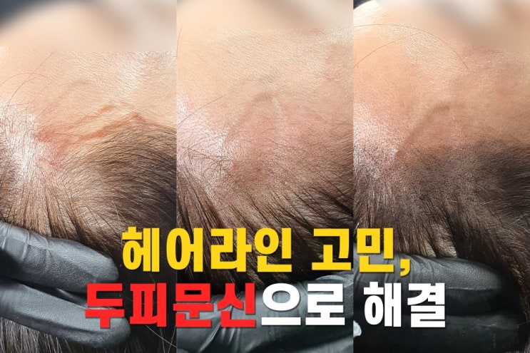 여자 헤어라인 머리숱 고민, 지워지지 않는 인계동 헤어라인SMP로