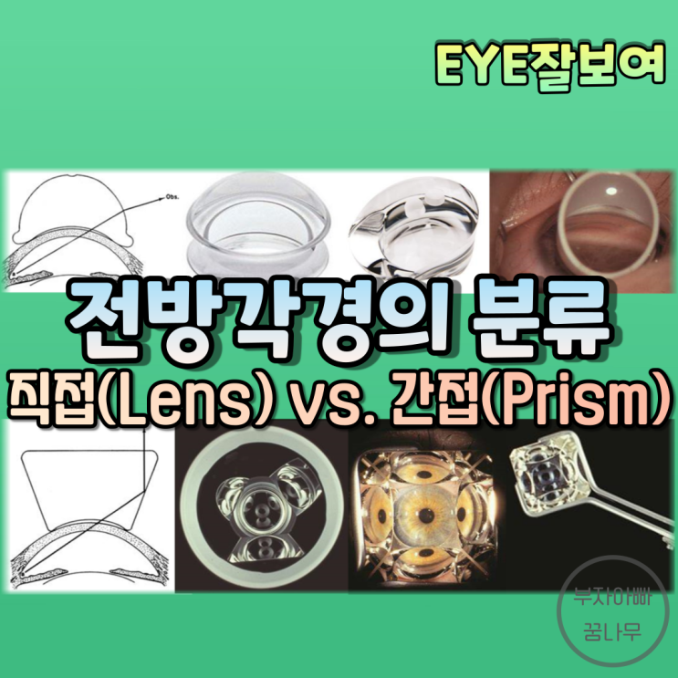  [EYE잘보여] 전방각경(Gonioscopic Lens)의 분류 - 직접 전방각경 vs. 간접 전방각경