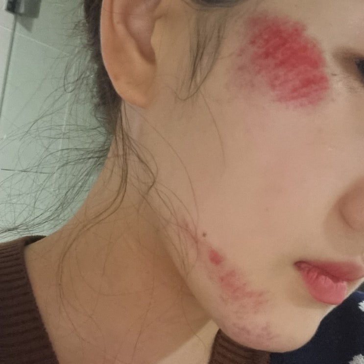  얼굴 아스팔트 찰과상 회복과정